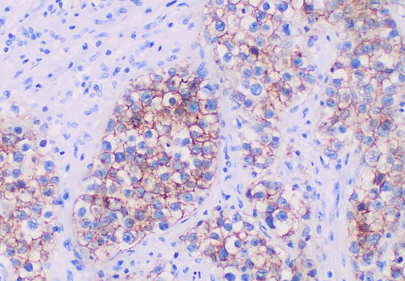 File:Positive CD117 immunohistochemistry in seminoma.jpg