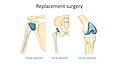 Replacement surgery - Shoulder total hip and total knee replacement