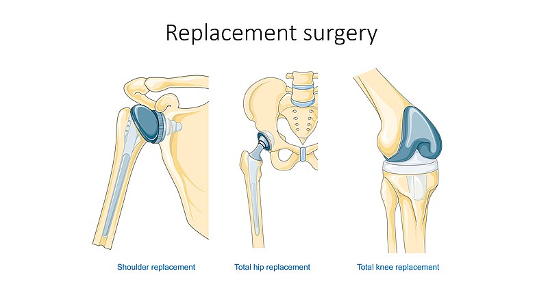 File:Replacement surgery - Shoulder total hip and total knee replacement -- Smart-Servier.jpg