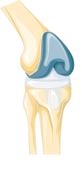 File:Replacement surgery - Total knee replacement -- Smart-Servier.png