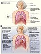 Respiratory failure