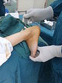 صورة أثناء اجراء جراحة على وتر العرقوب (Achilles tendon) لإطالته من أجل تحسين المشي والوقوف ، و تُرى القدم في حالة انثناء ظهراني (أو ثني خلفي) (dorsiflexion).