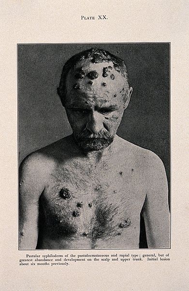 File:Syphilis; skin eruptions on head and chest, c 1905 Wellcome V0010347ER.jpg