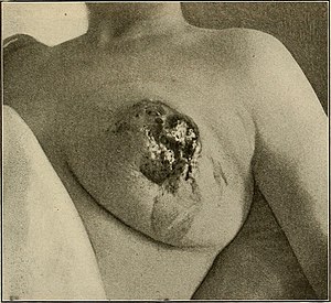 The breast- its anomalies, its diseases, and their treatment (1917) (14756739992).jpg