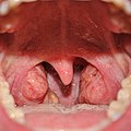 Anterior photograph of the oral cavity showing palatine tonsils (inflamed) and uvula.