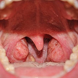 Keelamandel: Orgaan achter in de keel