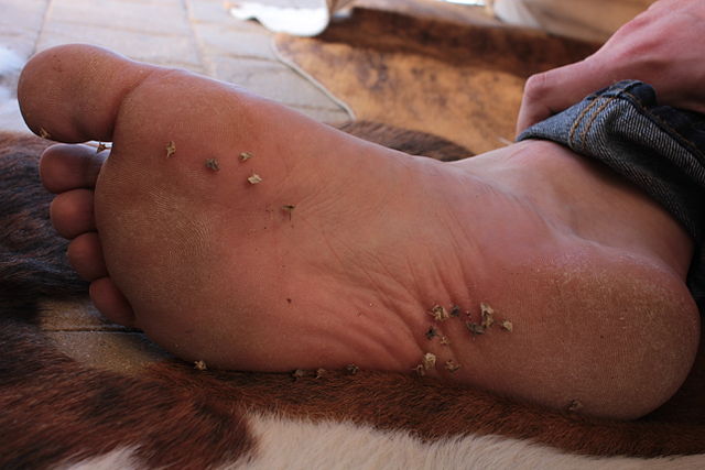 Caltrop, Tribulus terrestris, is sometimes considered a pest plant because of its sharp spiny burrs, shown here in a person's foot.