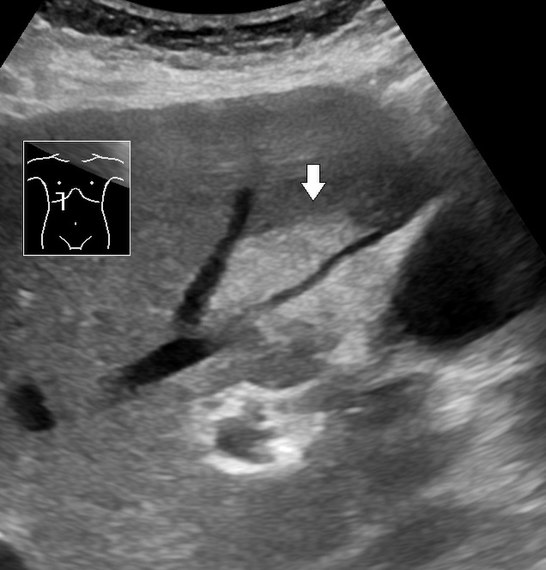 Abdominal ultrasonography of focal steatosis. It is distinguished from a tumor by not compressing the hepatic vein.