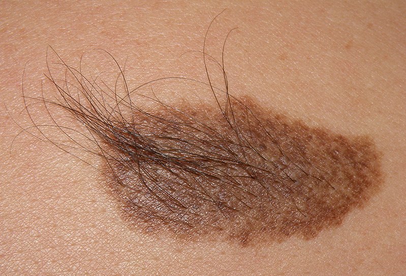 File:Becker's nevus of shoulder.JPG