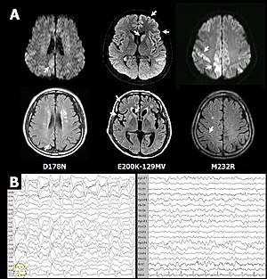 CJD profiles of MRI and EEG from probable CJD patient