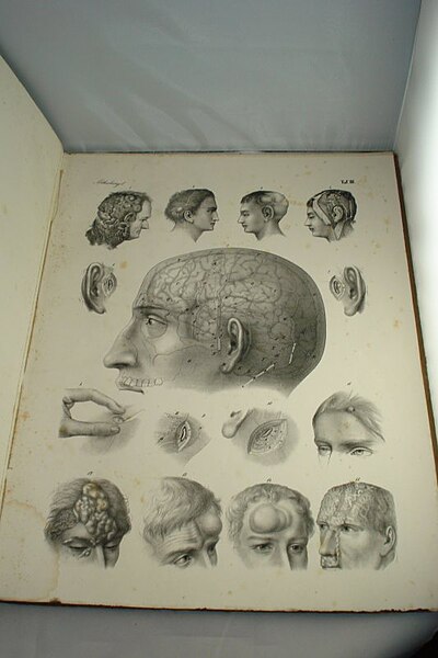 Chirurgischer Atlas der chirurgischen Krankheiten von Dr. Victor Bruns, 1853 (13).jpg