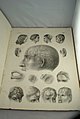 Chirurgischer Atlas der chirurgischen Krankheiten von Dr. Victor Bruns, 1853 (13).jpg