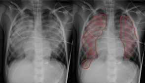 Chest X-ray of Pulmonary Edema with lines and overlay showing congestion Comparison PE.png