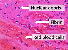 Composition of a fresh thrombus at microscopy, HE stain, showing nuclear debris in a background of fibrin and red blood cells. Composition of a fresh thrombus.jpg