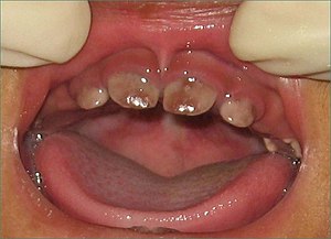 Congenital-erythropoietic-porphyria-1.jpg