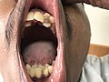 Hyperdontia - Genetically inherited development of overcomplete teeth. 4.jpg