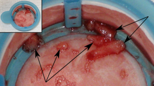 Intracoronary thrombus.png