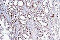 MSI-H colorectal adenocarcinoma - MSH2