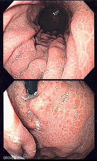 <span class="mw-page-title-main">Portal hypertensive gastropathy</span> Changes in the mucosa of the stomach in patients with portal hypertension