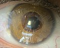 Thumbnail for Corneal tattooing