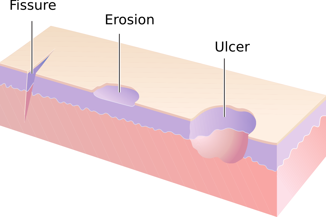 Skin fissure