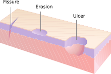 Schematic image comparing a skin fissure to an erosion and an ulcer. Ulcers, fissures, and erosions.svg