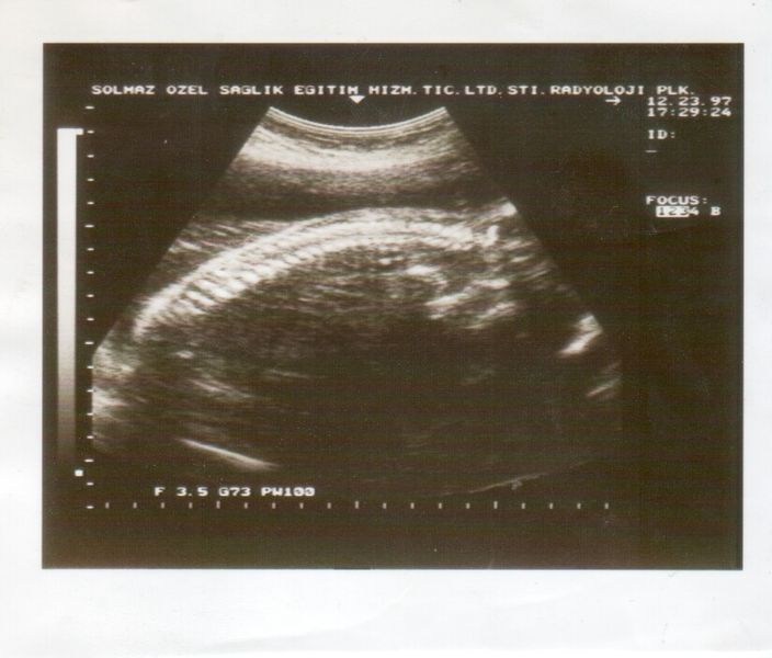 File:Ultrasound Scan ND 318.jpg