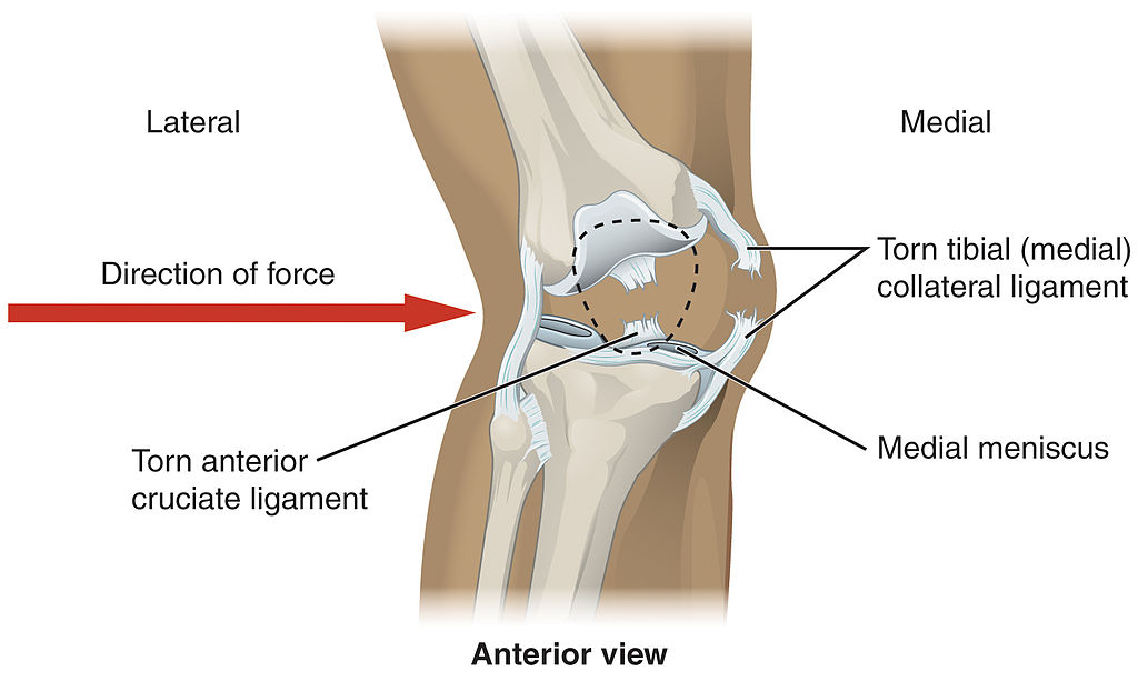 Torn Meniscus: Effective Treatment for Meniscal Injury - Back To Motion. Denver Physical Therapy.