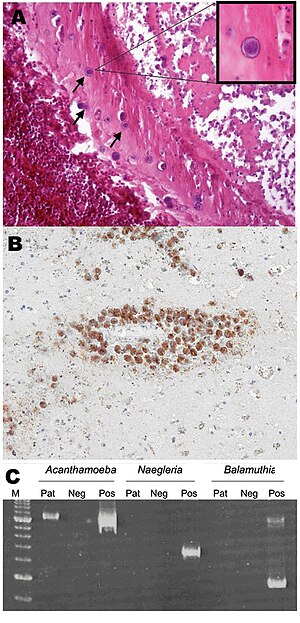 Acanthamoeba pathology