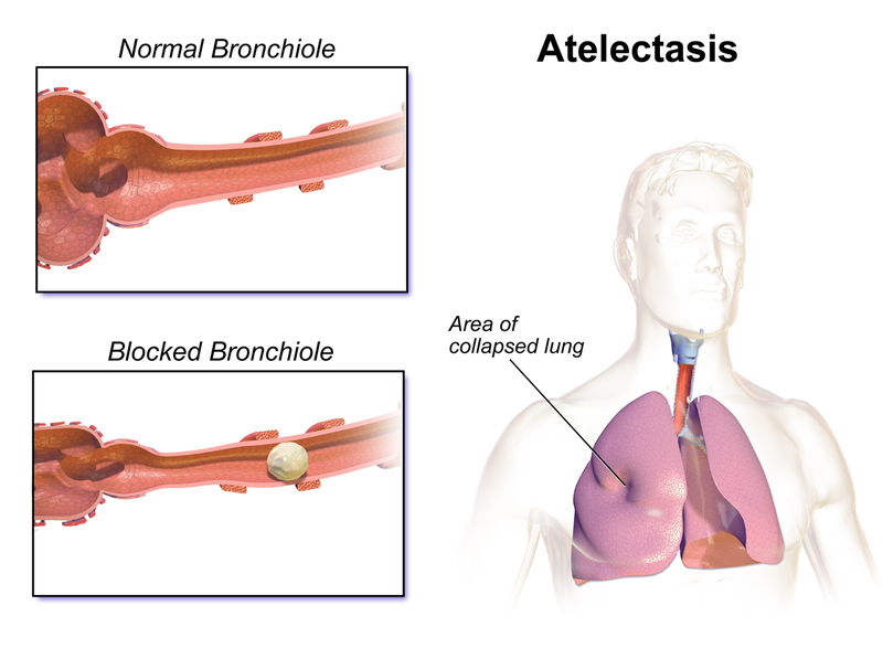 Atelectotrauma - Wikipedia
