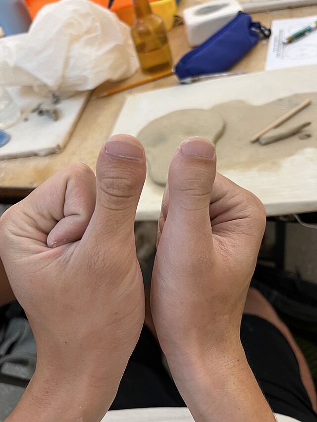 Case of Brachydactyly type D.