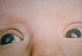 Cataracts due to Congenital Rubella Syndrome (CRS
