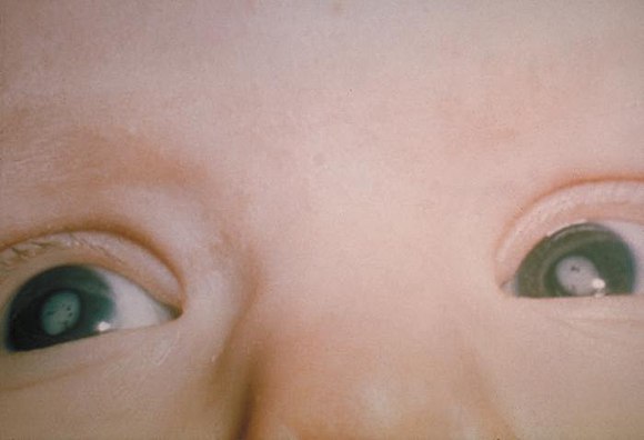 Child with cataracts in both eyes due to congenital rubella syndrome