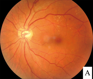 <span class="mw-page-title-main">Diabetic retinopathy</span> Medical condition