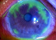 Fluorescein-stained cornea: geographic epithelial defects Herpes simplex geographic corneal ulcer.jpeg