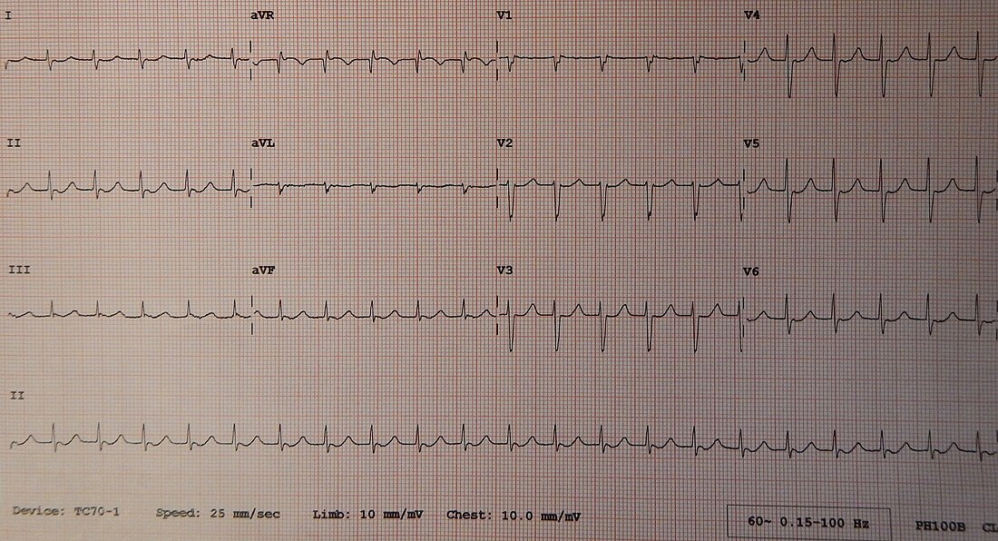 Junctional tachycardia