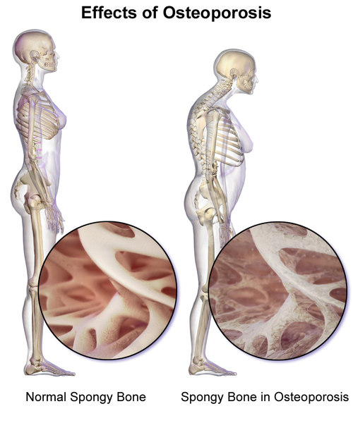 File:Osteoporosis 02.png