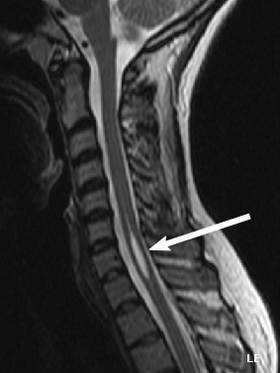 Syringomyelia (with arrow).png