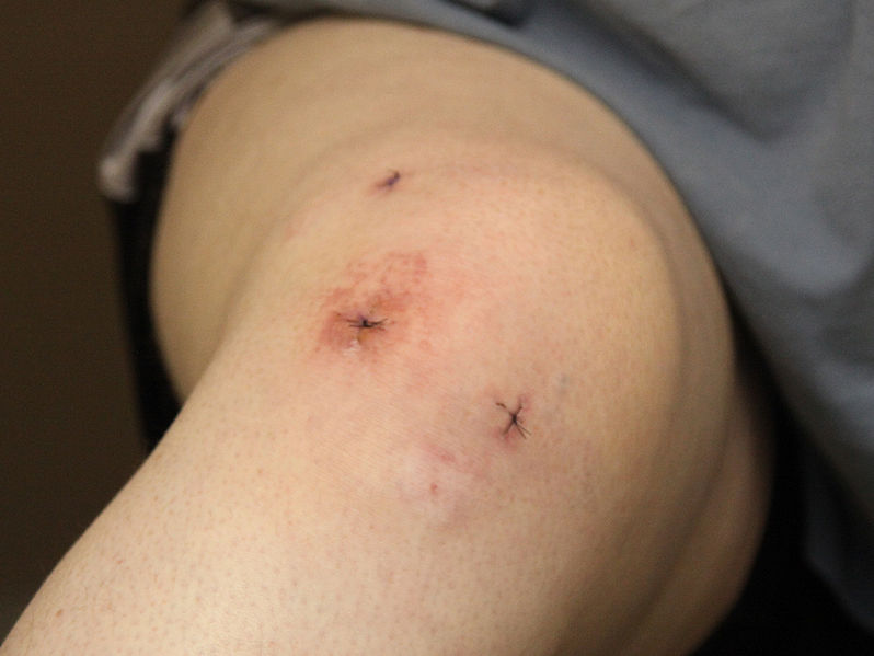 Fasciculus:Typical arthroscopic surgery incisions - knee.JPG