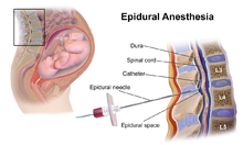 Epidural steroid injection nerve block