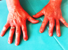 Hands post uric arthritis treatment.png