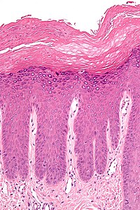 Hyperkeratosis (top) and acanthosis (below) in lichen simplex chronicus