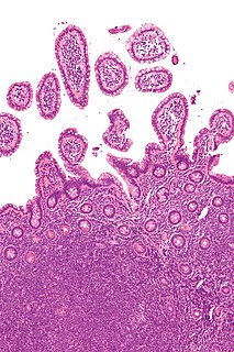 Mantle cell lymphoma