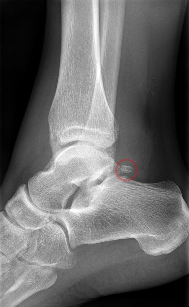 Deltoid Ligament Ankle Sprain التواء الكاحل بالرباط الدالي