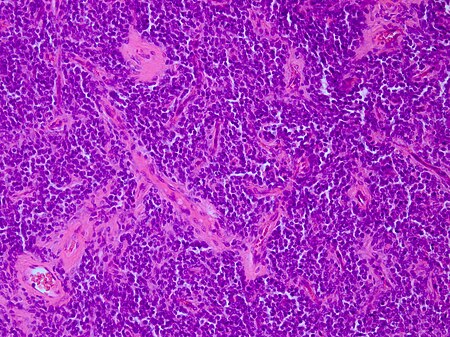 Micrograph of an H&E stained section of a peripheral PNET.