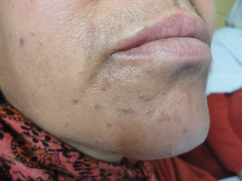 warts on face