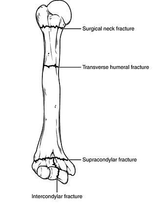 Surgical neck of the humerus - Wikipedia