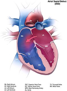 <span class="mw-page-title-main">Atrial septal defect</span> Human heart defect present at birth