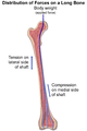 مثال توضيحي على توزيع قوى الشدّ والإنضغاط على أحد العظام الطويلة: عظم الفخذ.