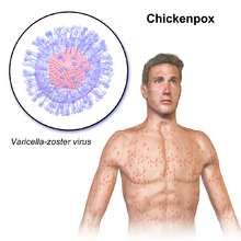 Early Symptoms of Chickenpox - Chickenpox Home Page